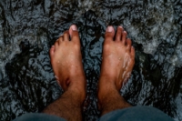 Hammertoe and Other Similar Toe Deformities